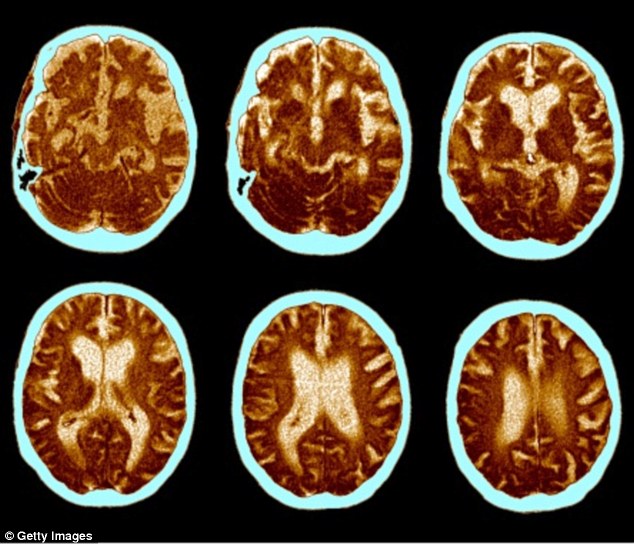 3AD4151E00000578 3979220 Health dangers Sophisticated imaging of 1 000 cannabis users bra a 21 1480351292656